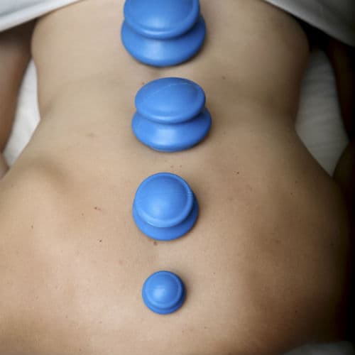 Blue cupping therapy cups placed along a client's spine